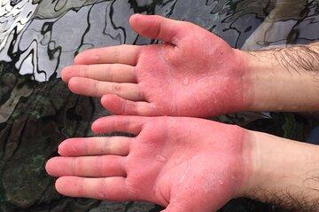 Psoriasis Fish Treatment by Garra Rufa Dr Fish in Turkey for 21 Days